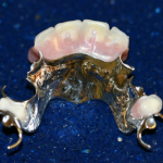 chrome denture