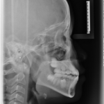 lateral cephalogram X-ray 
