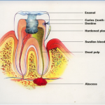 periapical abscess