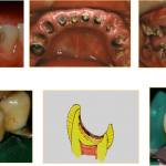 rampant caries