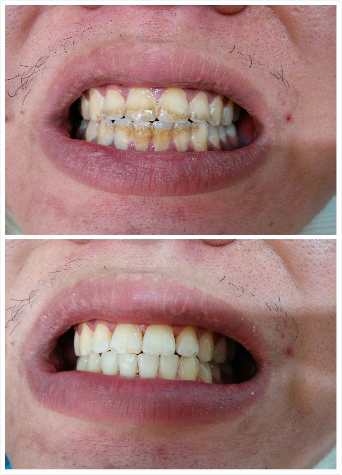 scaling-and-root-planing-save-a-smile-dental-clinic