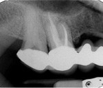 6-month post-op review radiograph 